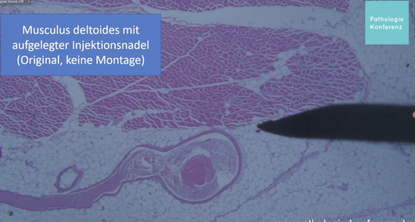 Bild: Screenshots Pathologie-Konferenz; Komposition Wochenblick/Eigenes Werk