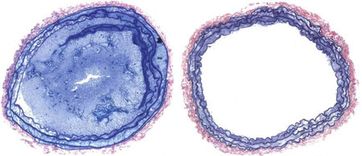 Das Bild links zeigt ein Blutgefäß mit Blutpfropf beim Wildtyp, das Bild rechts das Blutgefäß von einer Mutante ohne Kindlin-3-Protein - hier bildet sich kein Blutpfropf. Bild: MPI für Biochemie