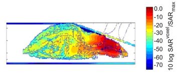 Das Computermodell diente als Berechnungsgrundlage der hirnfokussierten, elektromagnetischen Feldexposition ohne lokale Gewebeerwärmung. Rot weist auf den Bereich der gezielten Feldexposition hin.