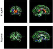 Bei übergewichtigen Frauen traten im Corpus callosum größere Veränderungen (rot markiert) auf als bei den männlichen Testpersonen. Max-Planck-Institut für Kognitions- und Neurowissenschaften