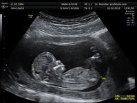 Ultraschalluntersuchungen schaden ungeborenen Kindern (Symbolbild)